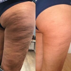 Celulitis Grados Tratamientos