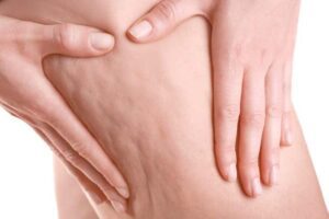 Celulitis Grados Tratamientos