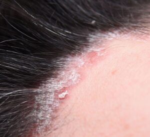 Dermatitis Seborreica: Tratamientos Efectivos
