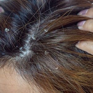 Dermatitis Seborreica: Tratamientos Efectivos