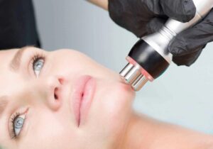 Radiofrecuencia Facial: Resultados Reales
