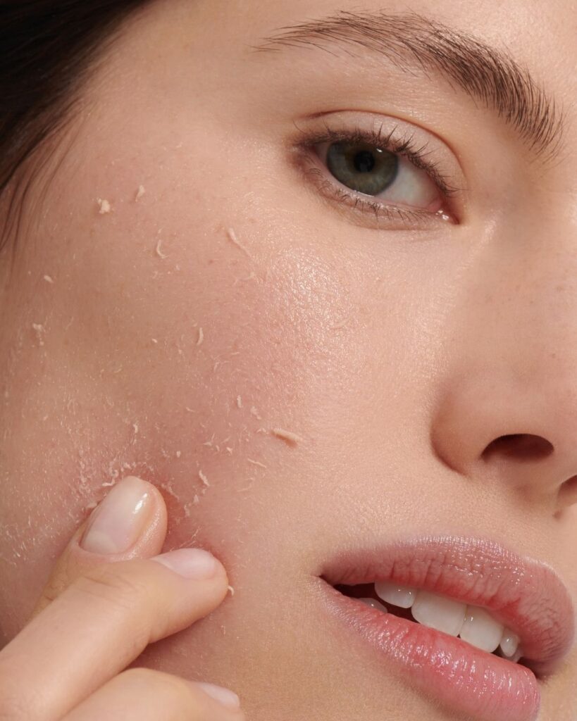Dermatitis Seborreica: Tratamientos Efectivos