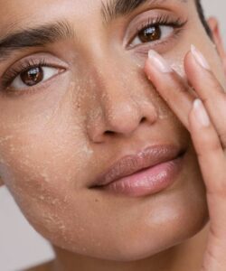 Dermatitis Seborreica: Tratamientos Efectivos