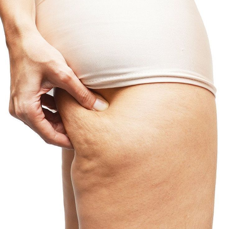 Celulitis Grados Tratamientos