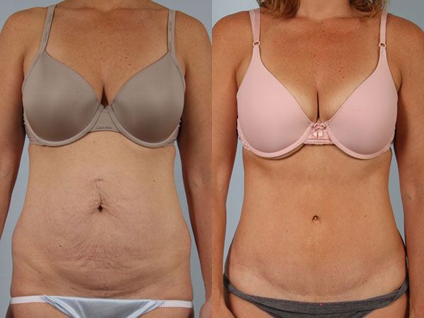 Abdominoplastia: cuándo sí es necesaria