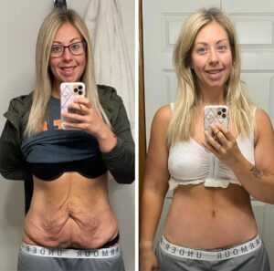 Abdominoplastia: cuándo sí es necesaria