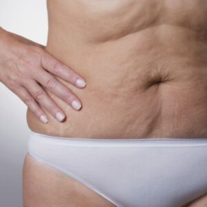 Flacidez corporal: causas reales
