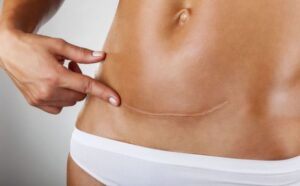 Abdominoplastia: cuándo sí es necesaria