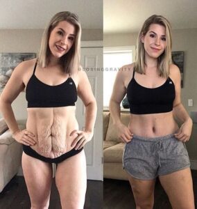Abdominoplastia: cuándo sí es necesaria